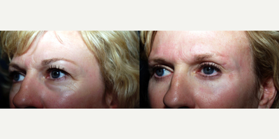 Eyelid Surgery before and after photo