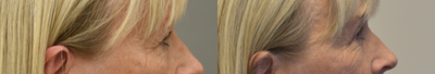 Eyelid Surgery before and after photo