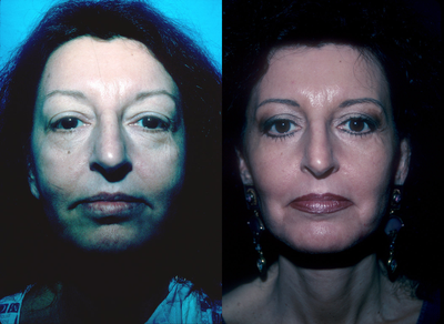 Facelift before and after photo