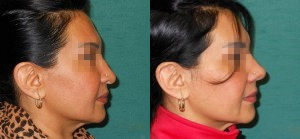 Rhinoplasty before and after photo