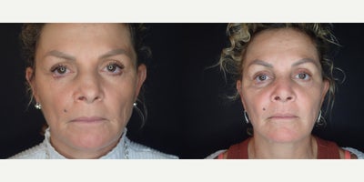 Rhinoplasty before and after photo