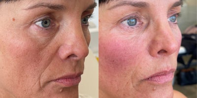 Dermal Fillers before and after photo