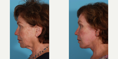 Facelift before and after photo