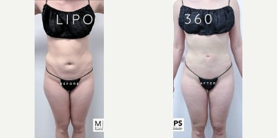 Liposuction before and after photo