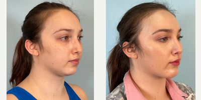 Morpheus8 before and after photo