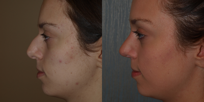 Rhinoplasty before and after photo