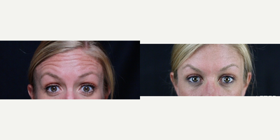 Botox before and after photo