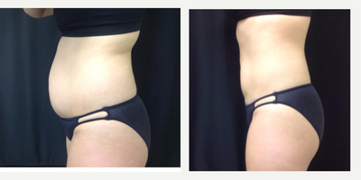 CoolSculpting before and after photo