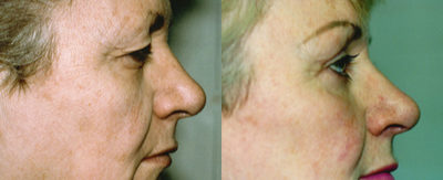 Eyelid Surgery before and after photo