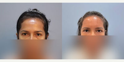 Facial Fat Transfer before and after photo