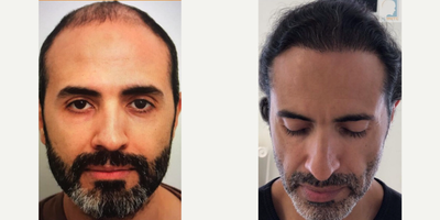 FUE Hair Transplant before and after photo