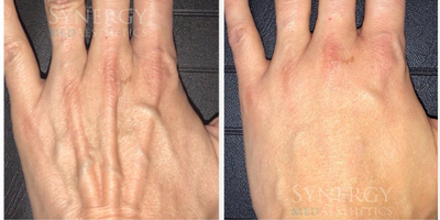 Hand Rejuvenation before and after photo