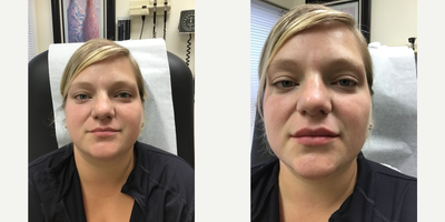 Lip Fillers before and after photo