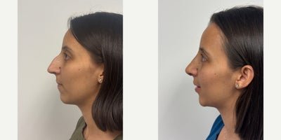 Rhinoplasty before and after photo