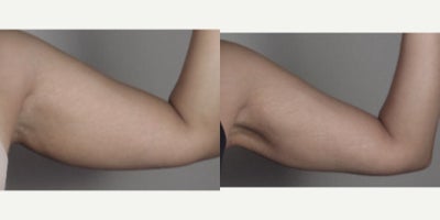 Arm Lift before and after photo