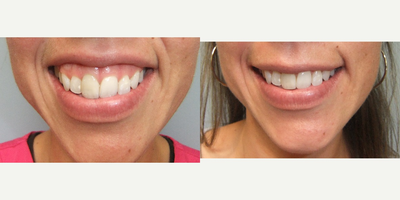 Botox for Gummy Smile before and after photo
