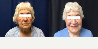 Facelift before and after photo