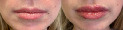 Lip Fillers before and after photo