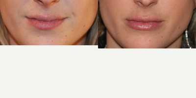 Restylane before and after photo