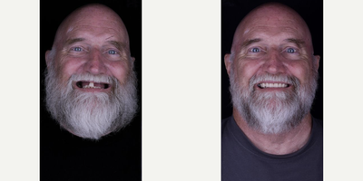 All-on-4 Dental Implants before and after photo