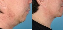 Chin Implant before and after photo
