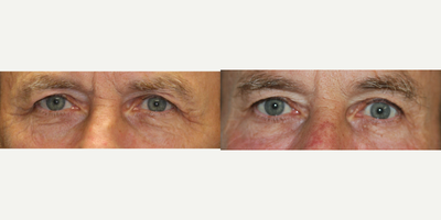 Dermal Fillers before and after photo
