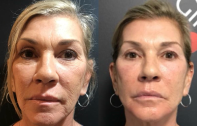 Dermal Fillers before and after photo
