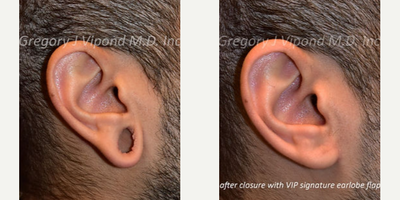 Earlobe Repair before and after photo