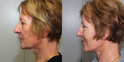 Facelift before and after photo
