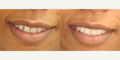 Invisalign before and after photo
