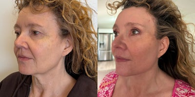 Neck Lift before and after photo