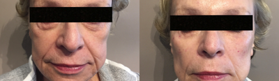 Nonsurgical Facelift before and after photo