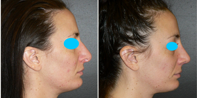 Revision Rhinoplasty before and after photo