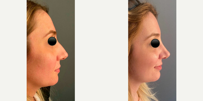 Rhinoplasty before and after photo