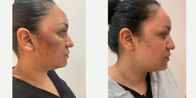 Chemical Peel before and after photo