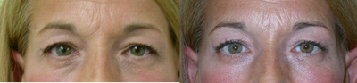 Eyelid Surgery before and after photo