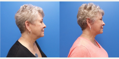 Facelift before and after photo