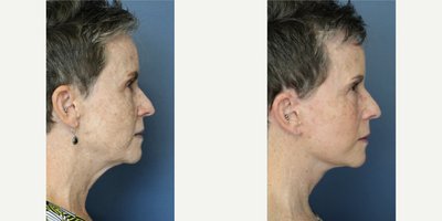 Facelift before and after photo