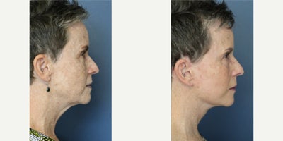 Facelift before and after photo