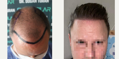 Hair Transplant before and after photo