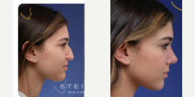 Rhinoplasty before and after photo
