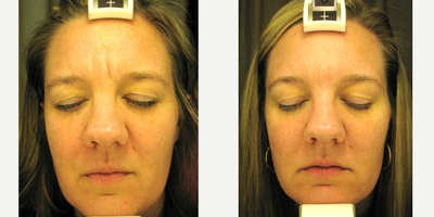 Dermal Fillers before and after photo