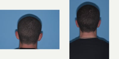 Ear Surgery before and after photo
