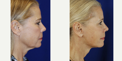 Facelift before and after photo