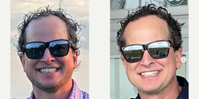 Hair Transplant before and after photo