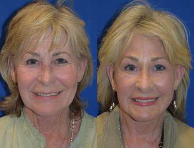 Renuvion for Facial Resurfacing before and after photo