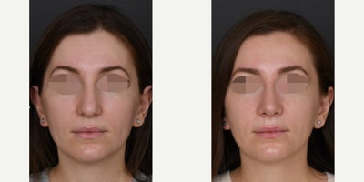Revision Rhinoplasty before and after photo