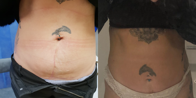 Tummy Tuck before and after photo