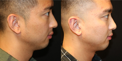 Chin Implant before and after photo