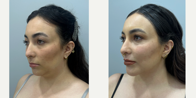 Chin Liposuction before and after photo